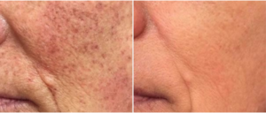 IPL Before and After