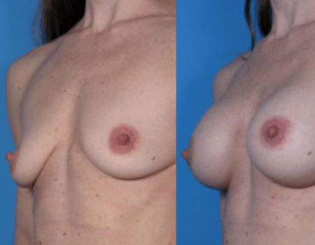 Breast Augmentation DC