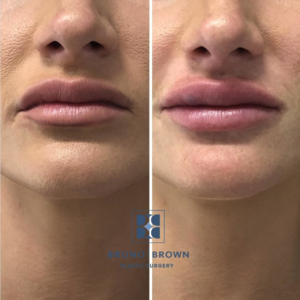 Lip Filler DC