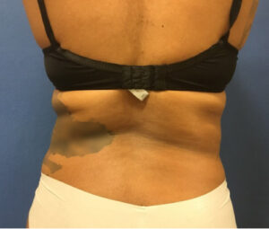 Before Bruno Brown Back Liposuction