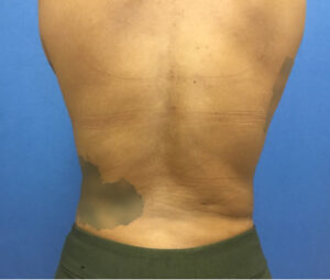 After Bruno Brown Back Liposuction