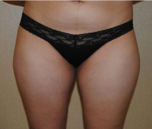 Before an Outer Thigh & Waistline Liposuction