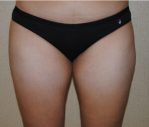 After an Outer Thigh & Waistline Liposuction