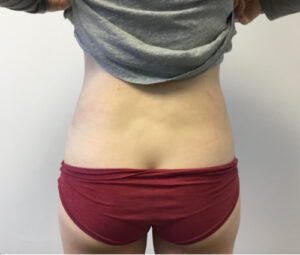 After a Bruno Brown Liposuction