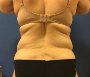 Before DC Tummy Tuck & Back Liposuction