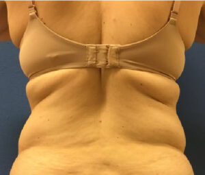 Before DC Tummy Tuck & Back Liposuction