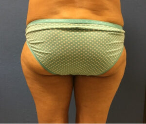 Before Bruno Brown Flank and Hip Liposuction