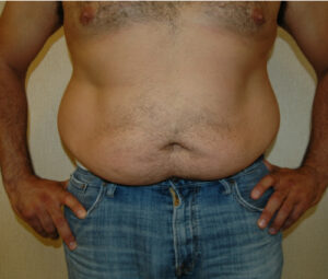 Middle aged man before receiving lipo for abs and love handles