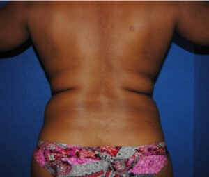 Middle aged woman before receiving lipo for love handles