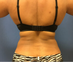 Middle aged woman after receiving lipo for love handles