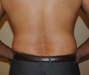 Man before receiving lipo for his love handles