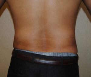 Man after receiving lipo for his love handles