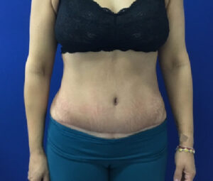 DC Plastic surgery results Bruno Brown