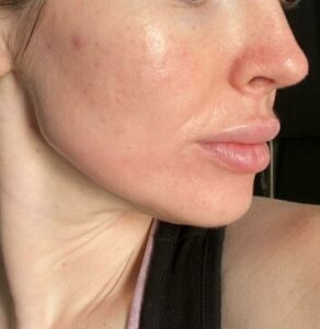 Microneedling results