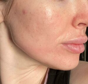after photo of a DC patient who received Microneedling with PRP treatment at Bruno Brown