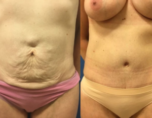 Tummy Tucks, Mommy Makeover