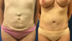Before after DC mommy makeover, great results