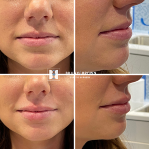 DC lip filler results at Bruno Brown