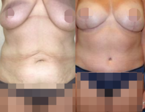 Before and after of a DC Mommy Makeover