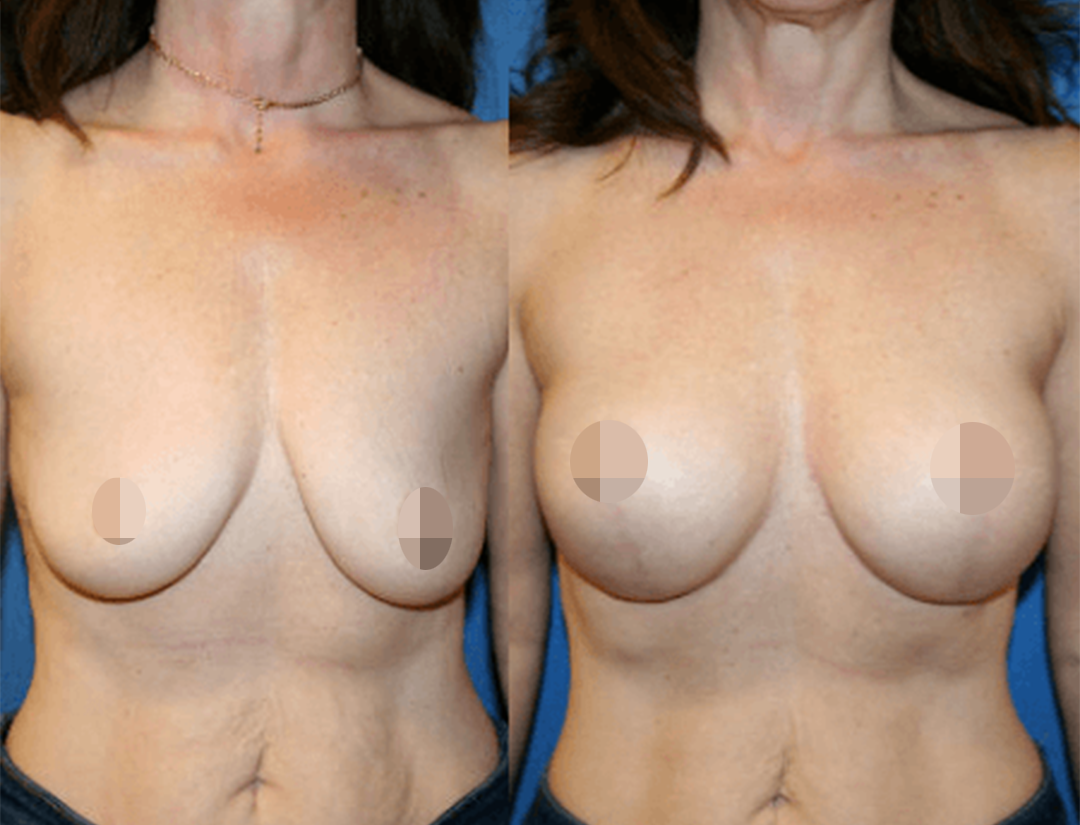 Breast lift