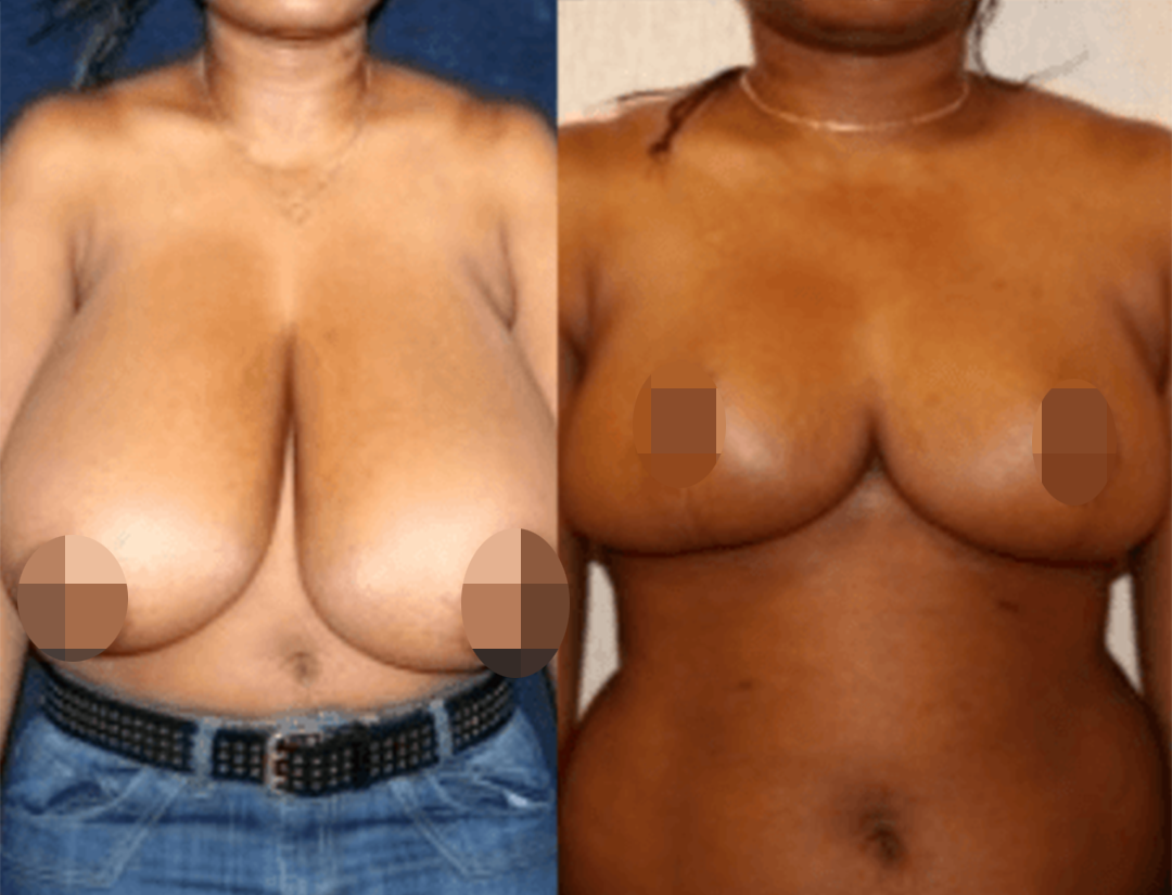 5 Things to Know About Breast Reduction Surgery