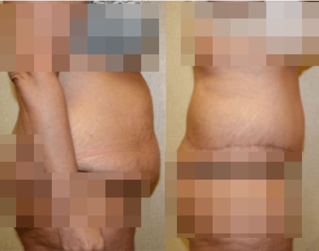 Tummy Tuck Surgery: Procedure, Preparation, & Recovery