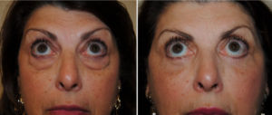 Blepharoplasty