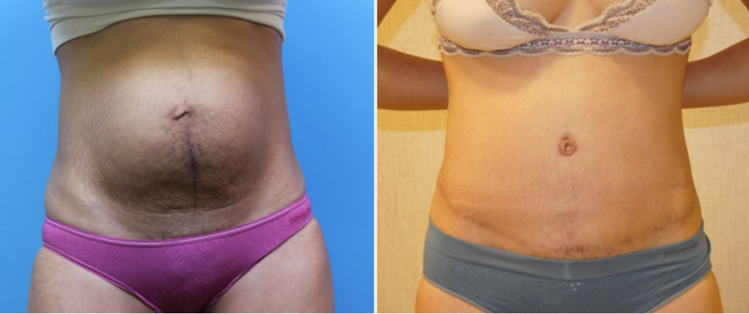 DC Tummy Tuck Before and After