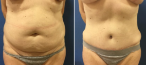 DC Tummy Tuck