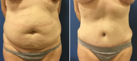 DC Tummy Tuck