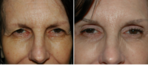 Blepharoplasty Procedure DC