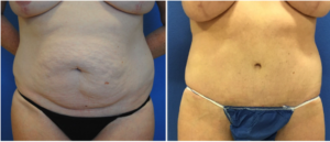 mommy makeover before and after surgery