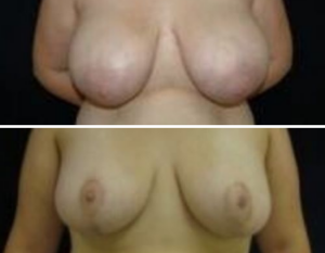 Breast Reduction before and after