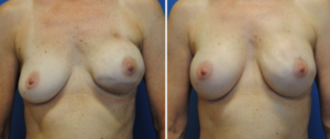 DC breast reconstruction before after