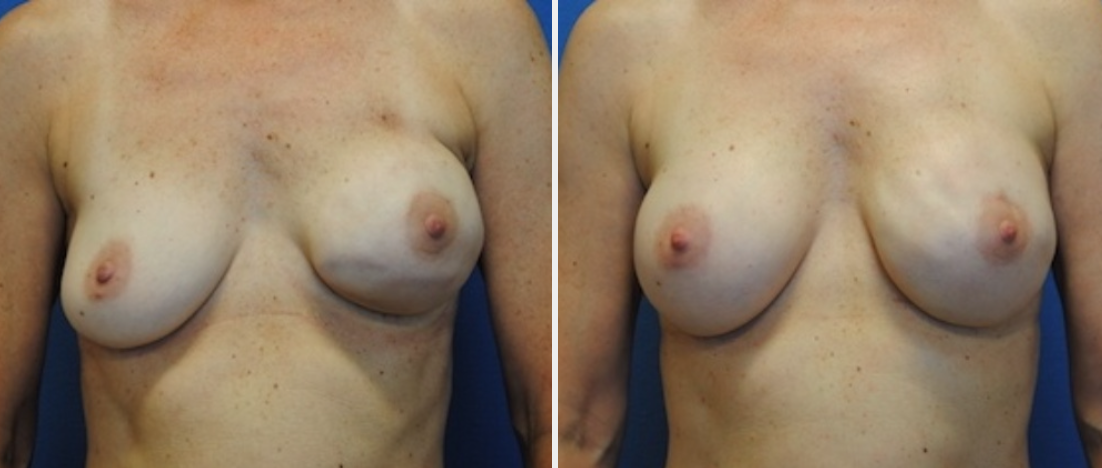 DC breast reconstruction before after