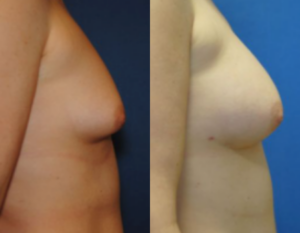 Breast Augmentation With Fat Grafting, before and after