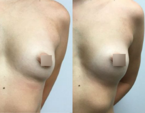 Breast Augmentation with Fat Grafting DC, before and after