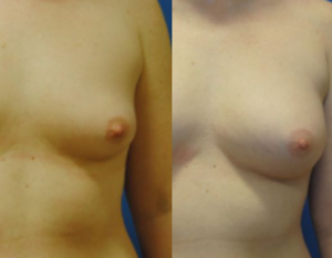 Fat Grafting Breast Augmentation, DC