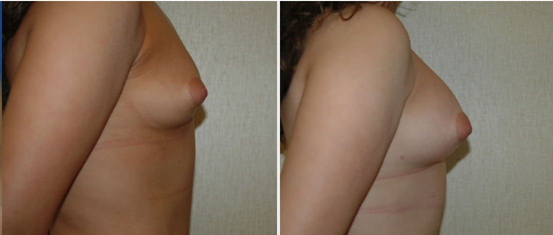 DC Fat Grafting Breast Augmentation, before and after