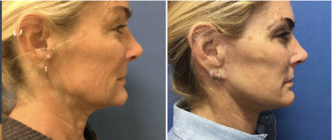 DC Facelift, before and after