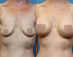 DC mommy makeover, before and after, dc plastic surgery
