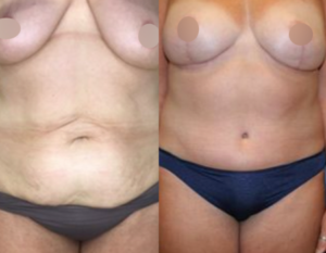 mommy makeover dc, before and after
