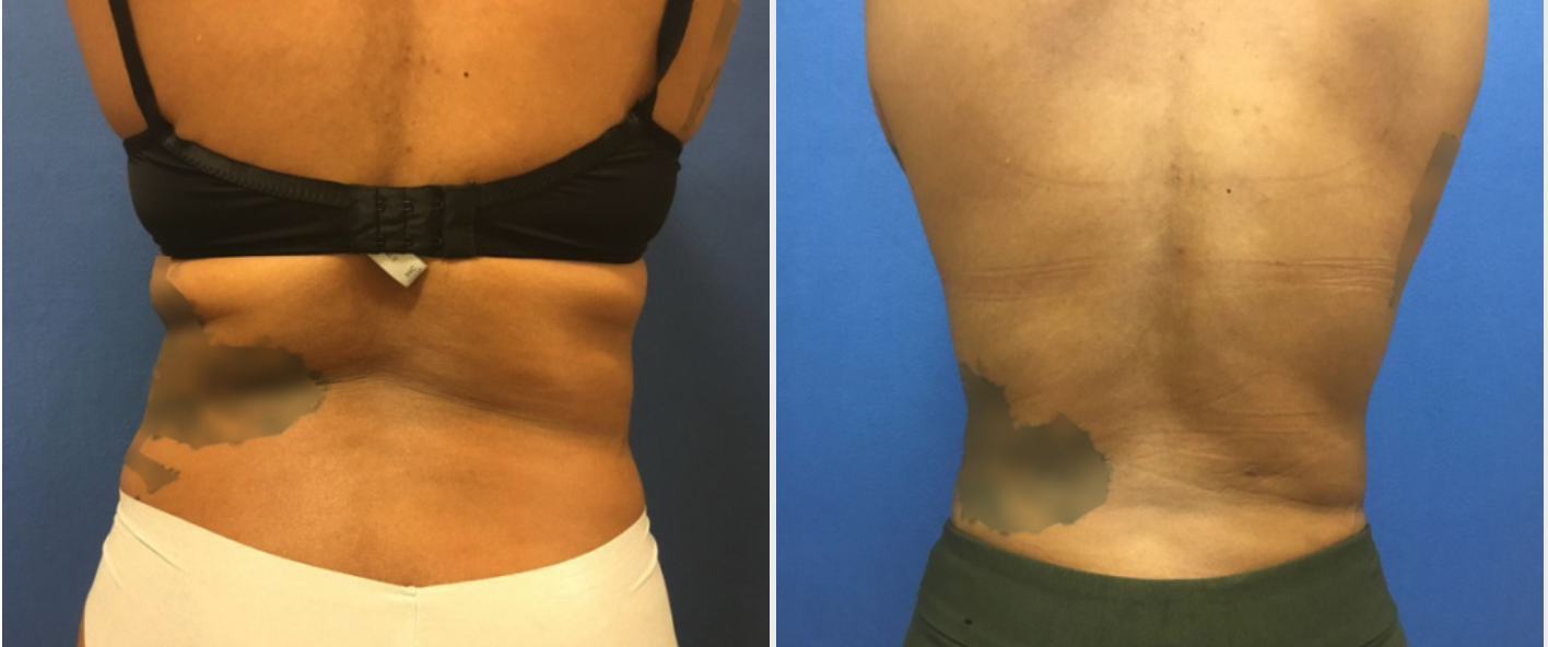 Liposuction Chevy Chase Before and After Back