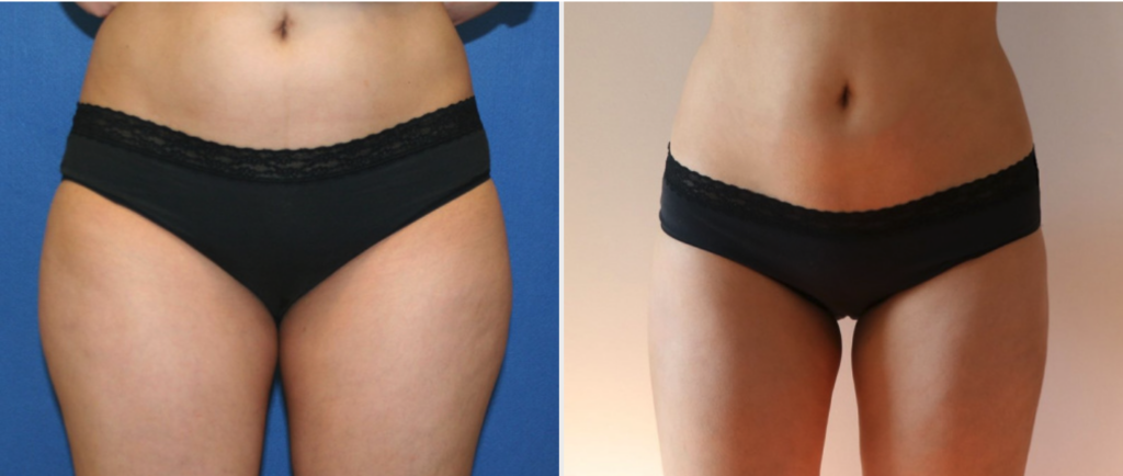 Results of Liposuction DC