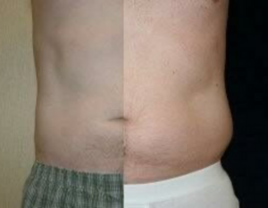 Liposuction Before and After