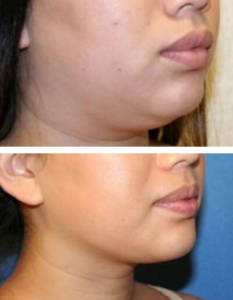 Chin Liposuction before and after