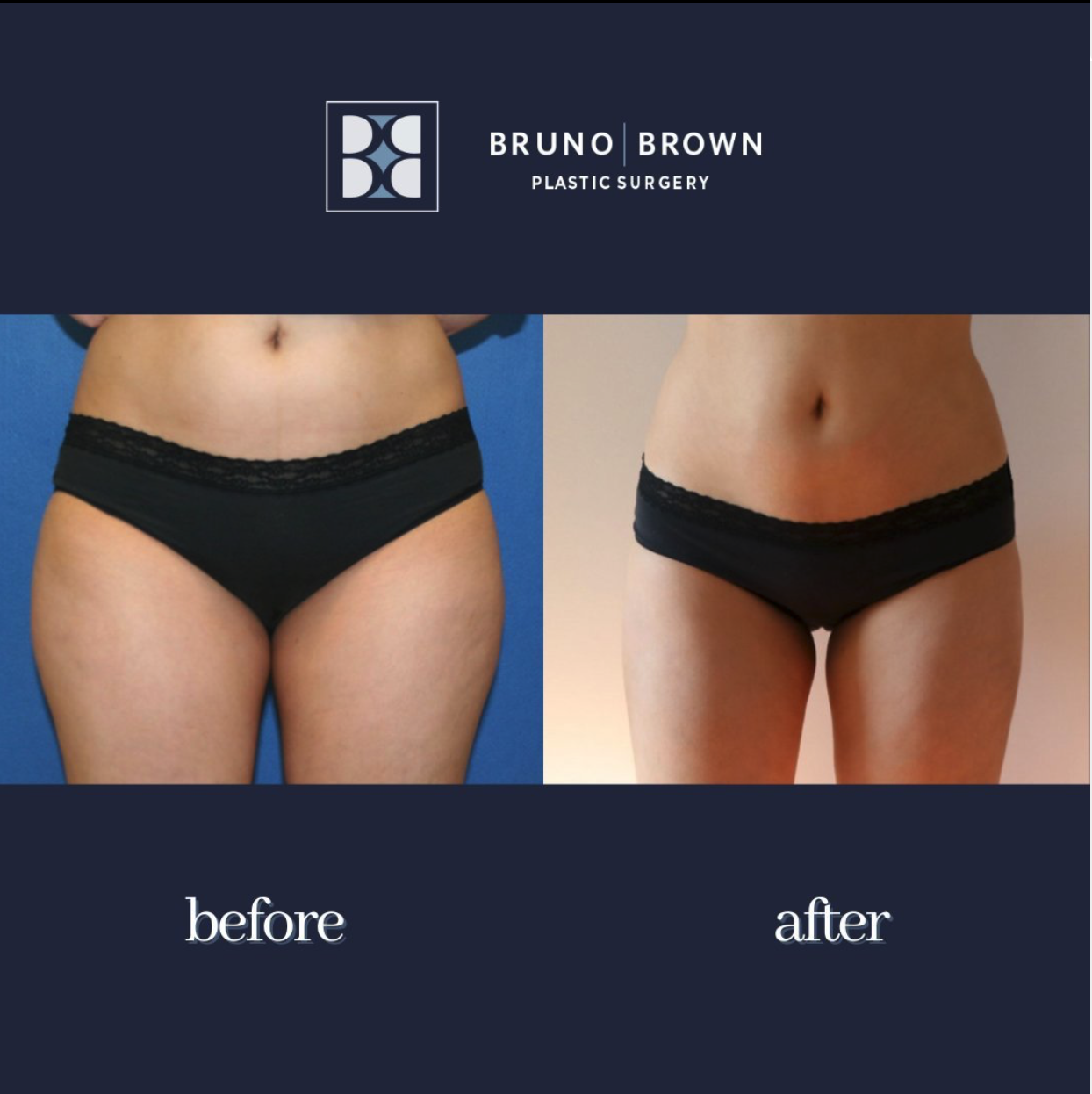 before and after abdomen liposuction surgery