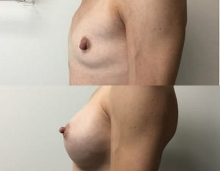 A before and after breast augmentation surgery 