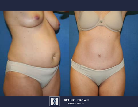 Before and after tummy tuck