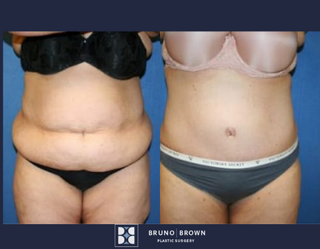 Transform your Confidence: Tummy Tucks and Liposuction in Bethesda, MD